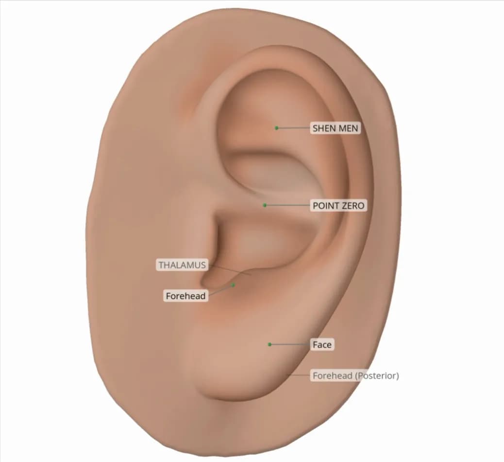 Example Protocol for Bell's Palsy, shown on a 3D ear in Auriculo 360.