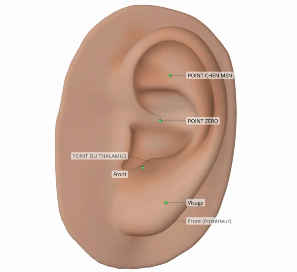 Exemple de protocole pour paralysie de Bell, shown on a 3D ear in Auriculo 360.