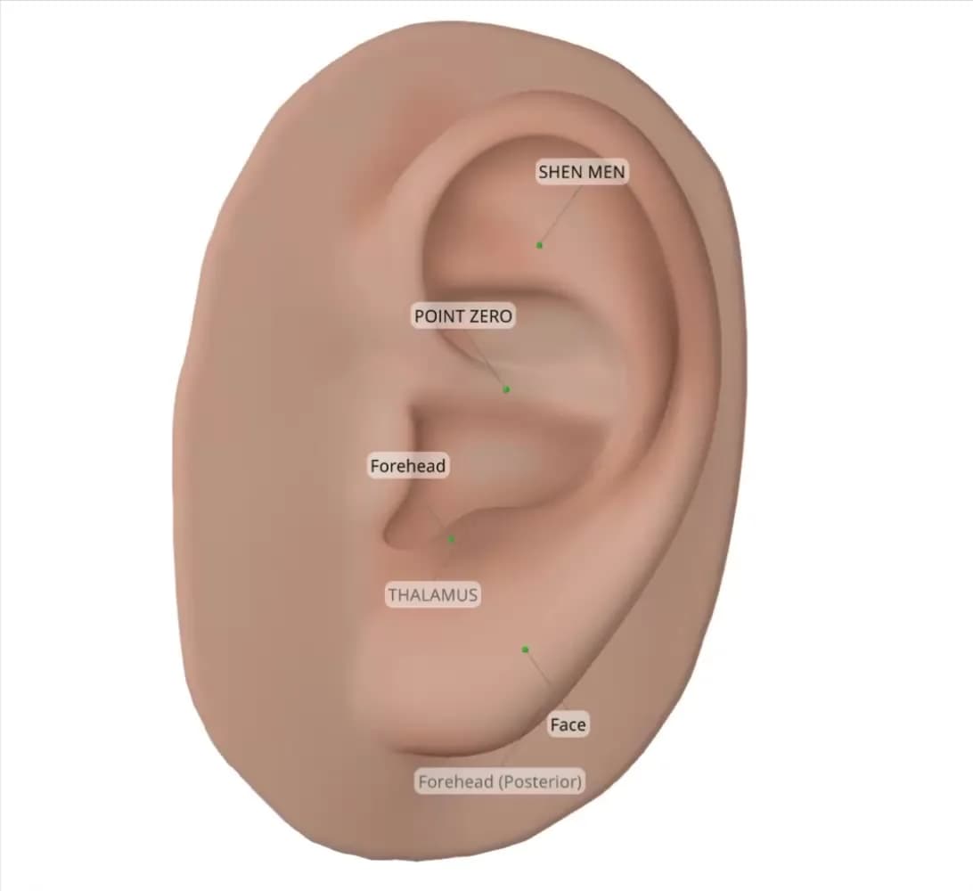 Beispielprotokoll für Fazialisparese, shown on a 3D ear in Auriculo 360.