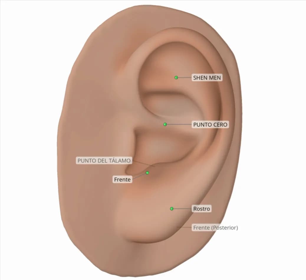 Protocolo de ejemplo para parálisis de Bell, shown on a 3D ear in Auriculo 360.
