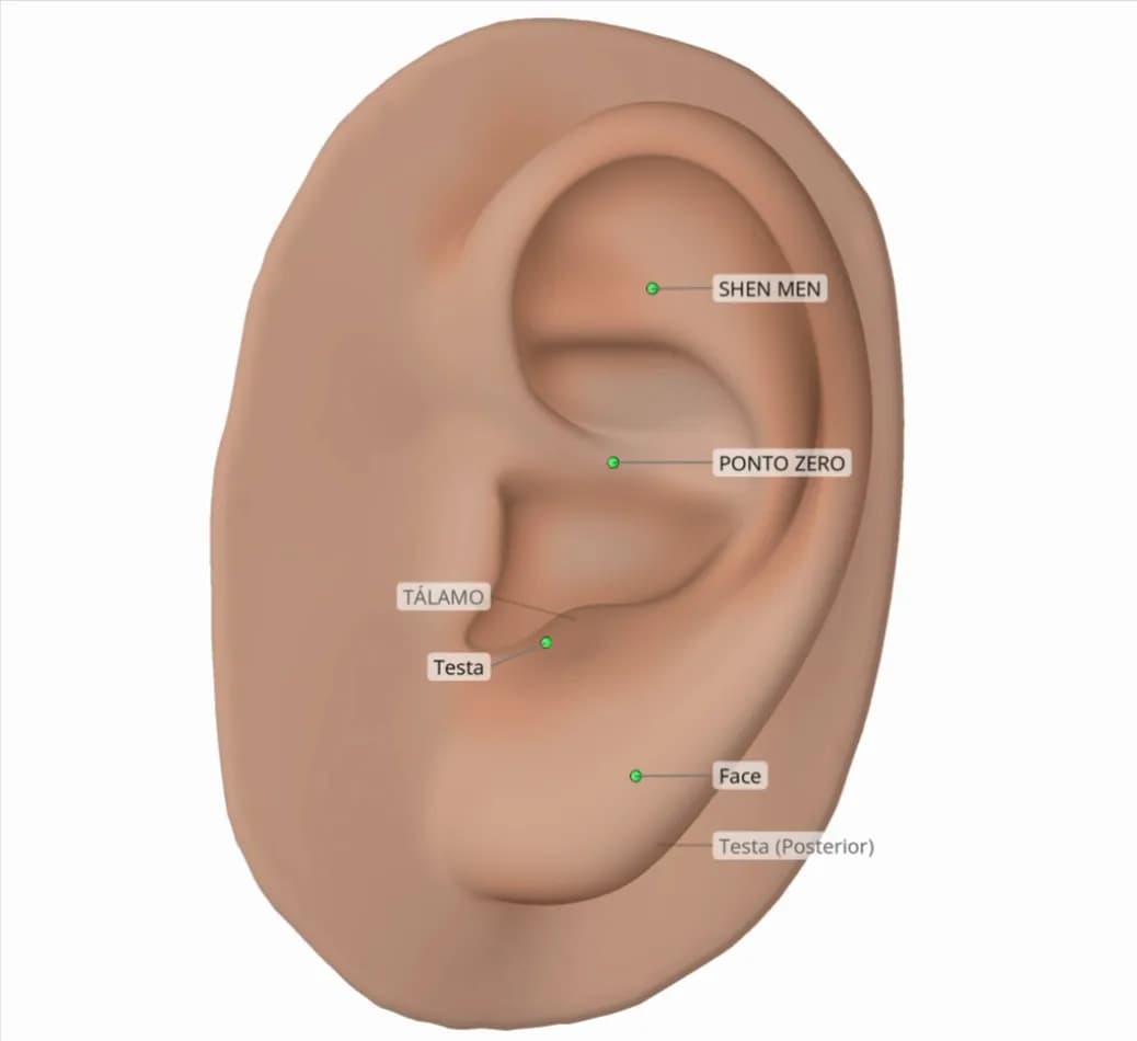 Protocolo de exemplo para paralisia de Bell, shown on a 3D ear in Auriculo 360.